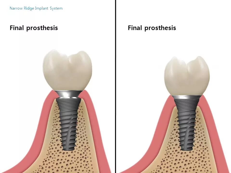 Имплантаты Dentium Superline. Корейские импланты Dentium Superline. Имплант Dentium Корея. Импланты Dentium (Дентиум). Имплант лайн