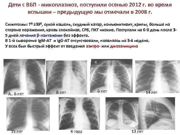 Пневмония признаки у взрослых. Пневмония симптомы. Пневмония симптомы у взрослых. Симптомы при воспалении легких у взрослого. Воспаление лёгких симптомы у взрослых.