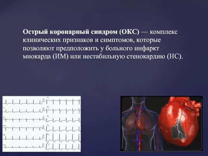 Варианты острого инфаркта миокарда