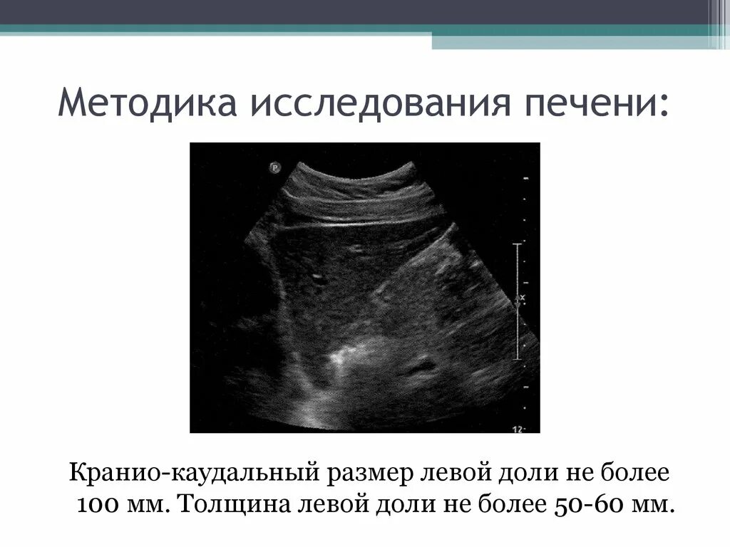 Размеры печени по узи норма. Толщина левой доли печени в норме на УЗИ. Краниокаудальный размер левой доли печени УЗИ. Толщина левой доли печени на УЗИ. Краниокаудальный размер печени на УЗИ.