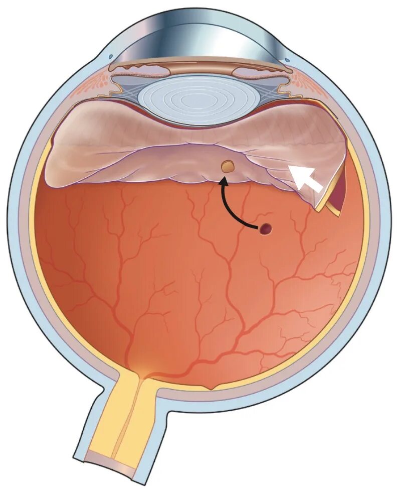 Пузыревидная отслойка сетчатки. Регматогенная отслойка сетчатки. Разрыв сетчатки (retinal tear). Кт глазном яблоке отслоение сетчатки кт. Замена сетчатки