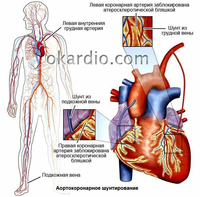 Шунт в медицине. Аортокоронарное шунтирование схема. Схема операции аортокоронарного шунтирования. Коронарное шунтирование сосудов сердца. Шунтирование артерий сердца.