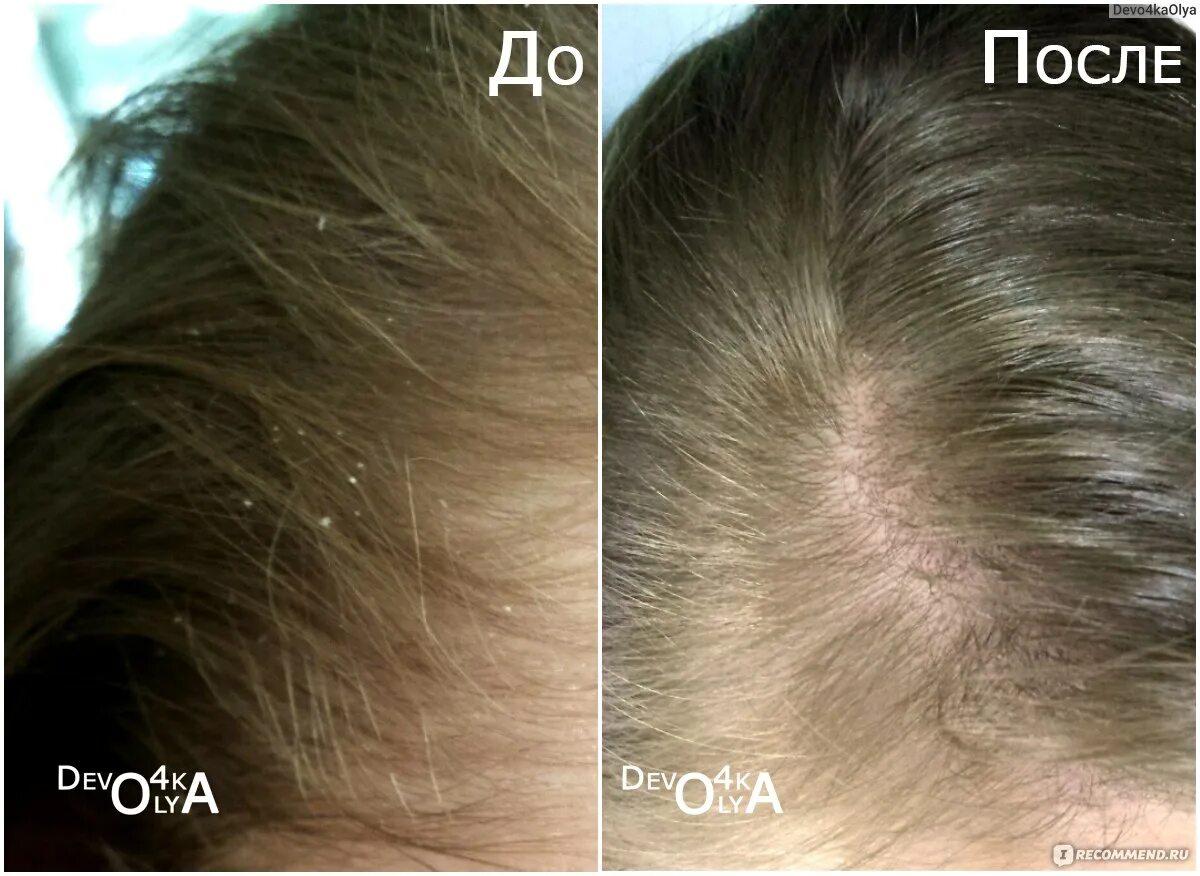 После мытья чешется. Волосы перхоть до после. Волосы после дегтярного шампуня. Волосы после мытья головы. Волосы после мытья дегтярным мылом.