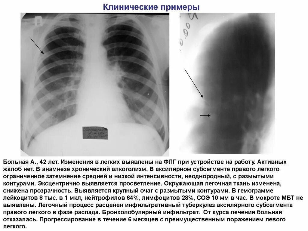 Фаза распада легких. Инфильтративный туберкулёз лёгких в фазе распада кт. Бронхолобулярный инфильтративный туберкулез. Инфильтративный туберкулез сегменты. Инфильтративный туберкулез в фазе распада s3.