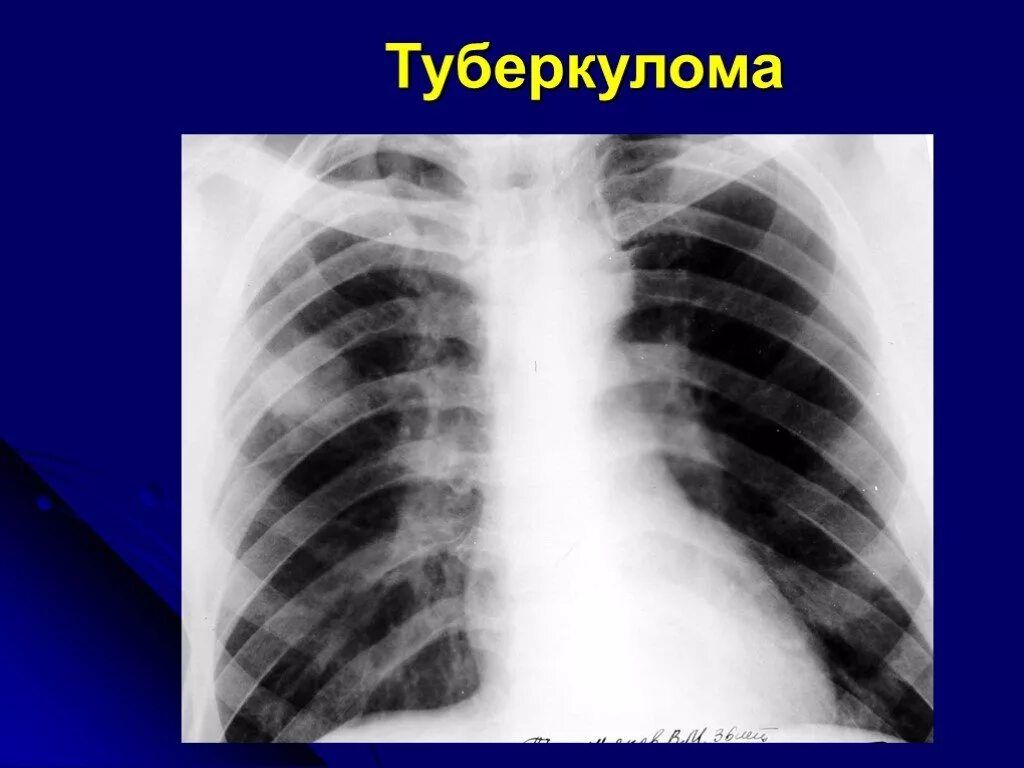 Шаровидная пневмония рентген. Туберкулема легкого рентгенограмма. Туберкулома верхней доли правого легкого. Туберкулома легких рентген. Очаговых изменений правого легкого