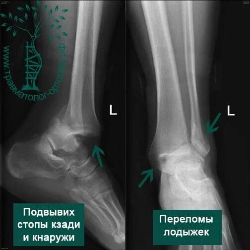 Перелом голеностопного сустава. Перелом Мальгеня лодыжки. Подвывих голеностопного сустава рентген. Подвывих стопы кзади рентген.