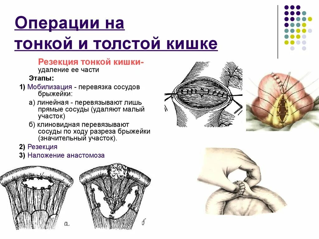 Операция толстой. Резекция тонкой кишки (этапы, виды межкишечных анастомозов). Клиновидная мобилизация тонкой кишки. Дополнительные инструменты при резекции кишки. Этапы операции резекция тонкого кишечника.