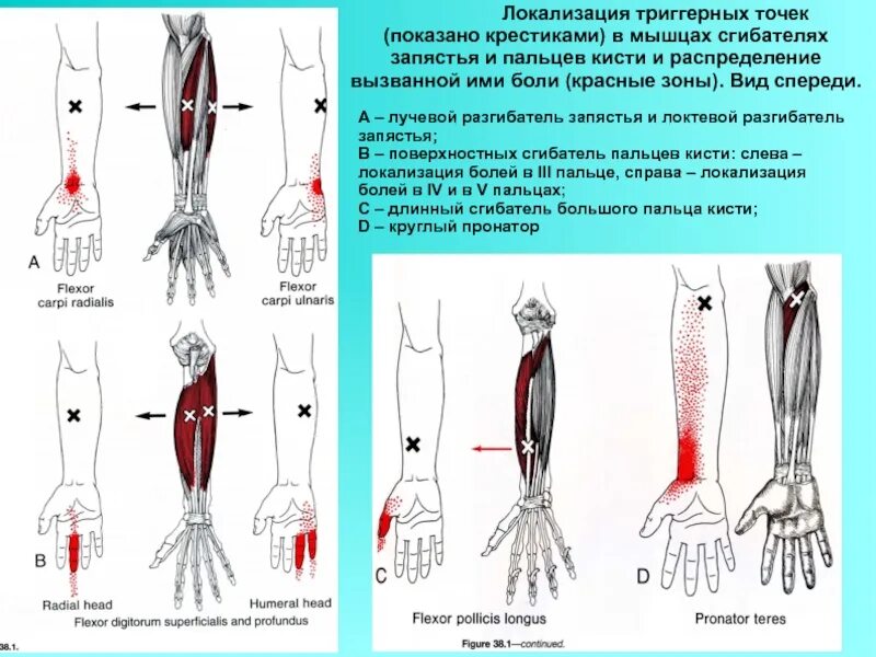 Локтевой сгибатель кисти мышца. Триггерные точки мышц верхних конечностей. Мышцы верхних конечностей сгибатель запястья. Локтевой сгибатель кисти болит. Триггерные точки это простыми словами