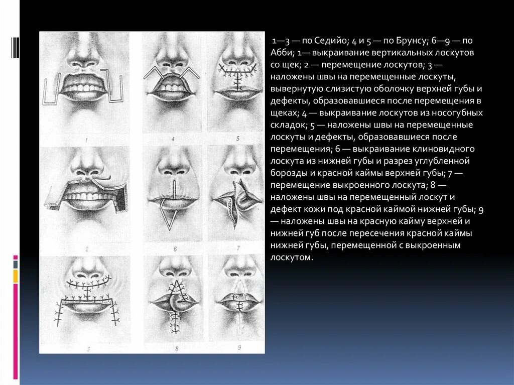 Операция нижней губы. Операция на губе по Брунсу. Пластика нижней губы по Брунсу. Резекция нижней губы пластика по Брунсу.