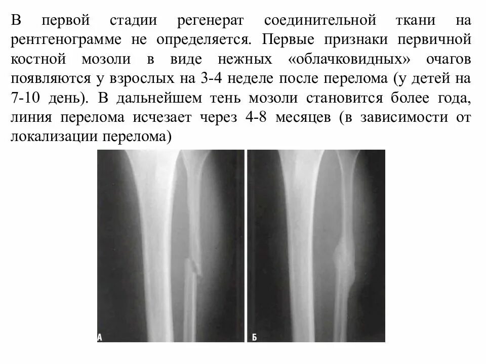 Перелом спустя неделю. Костная мозоль после перелома плечевой кости на рентгене. Костная мозоль после перелома на рентгене описание. Формирование костной мозоли при переломе голени. Параоссальная костная мозоль.