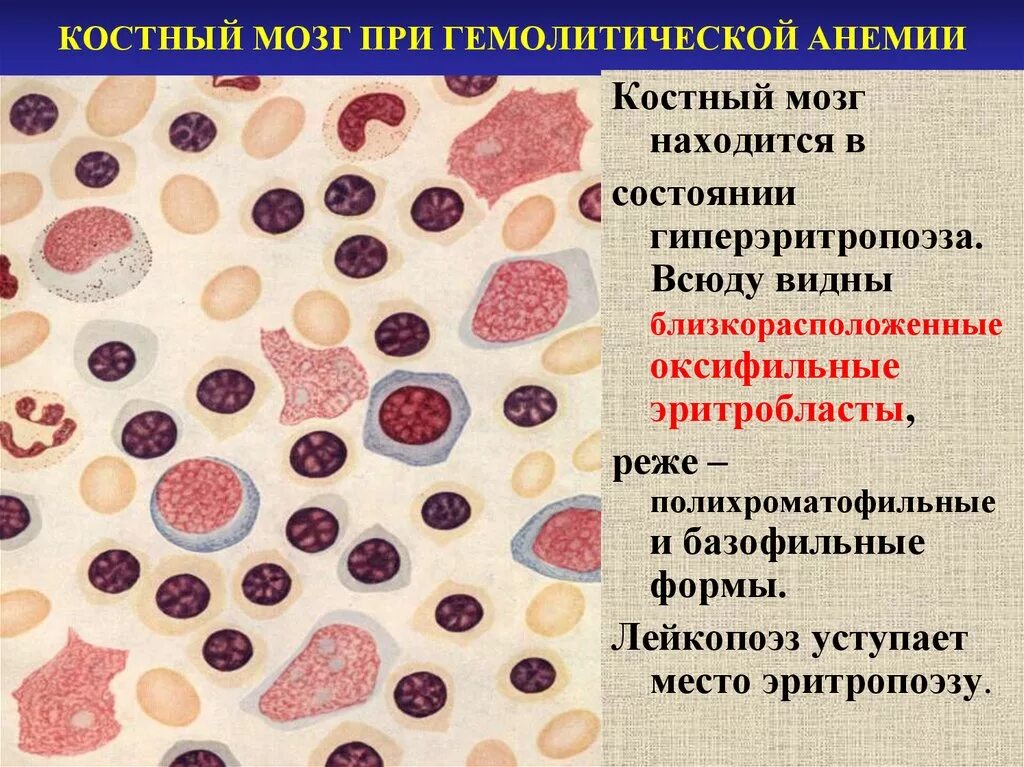 Гемолитическая анемия костный мозг. Гемолитическаяанемия картина кр. Апластическая анемия исследование костного мозга.