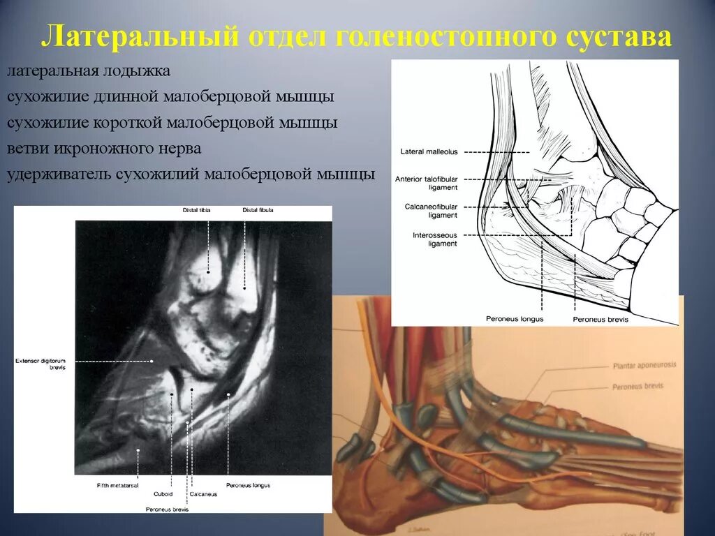 Латеральная лодыжка анатомия. Сумки голеностопного сустава анатомия мрт. Латеральная лодыжка мрт. Медиальная лодыжка анатомия.