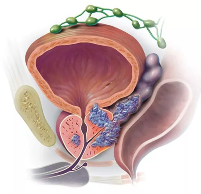 Стадии предстательной железы прогноз. ДГПЖ предстательной железы что это такое. Злокачественное новообразование предстательной железы. Карцинома предстательной железы. Тумор предстательной железы.
