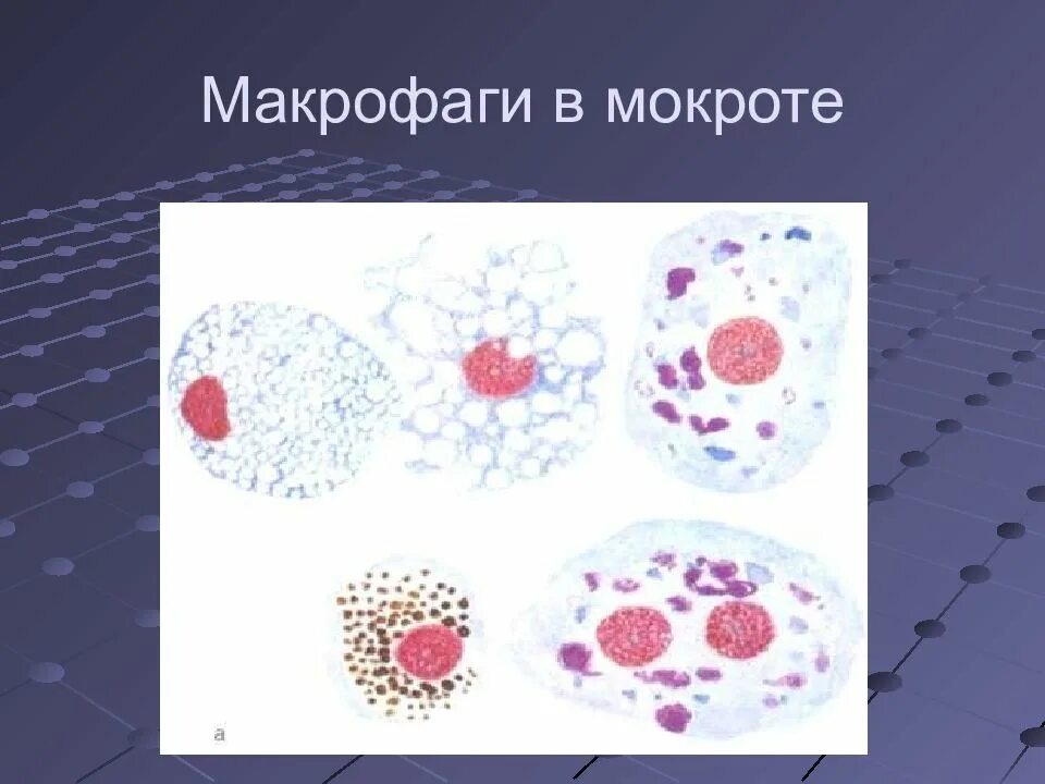 2 макрофаги. Альвеолярные макрофаги в мокроте. Альвеолярные макрофаги в мокроте нативный препарат. Альвеолярные макрофаги в мокроте микроскопия. Альвеолярные фагоциты в мокроте.