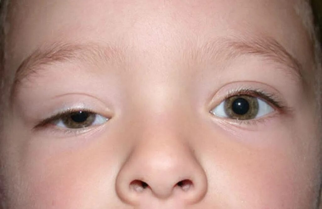 Глаза стали разного. Миастения птоз верхнего века. Врожденный птоз верхнего века. Блефарофимоз-птоз-эпикантус-синдром.