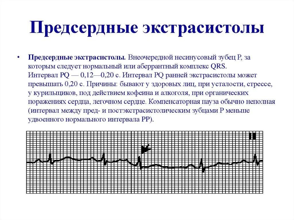 Сколько экстрасистол норма