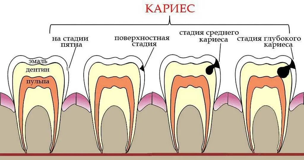 Стадии развития кариеса. Строение зуба кариес пульпит. Схема кариеса. Патогенез кариеса эмали. Реминерализация эмали зуба.