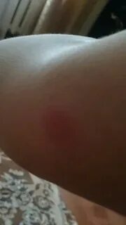 Снять зуд дома