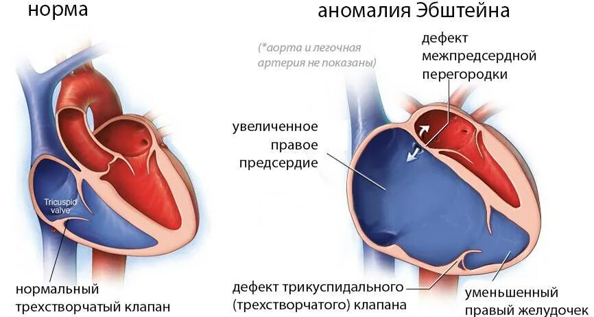 Аневризма перегородки у ребенка. Дефект межпредсердной перегородки схема. Порок сердца ДМПП У детей. Дефект межпредсердной перегородки нарушение гемодинамики. Дефект межпредсердной и межжелудочковой перегородки.