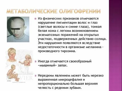 Умственная отсталость симптомы
