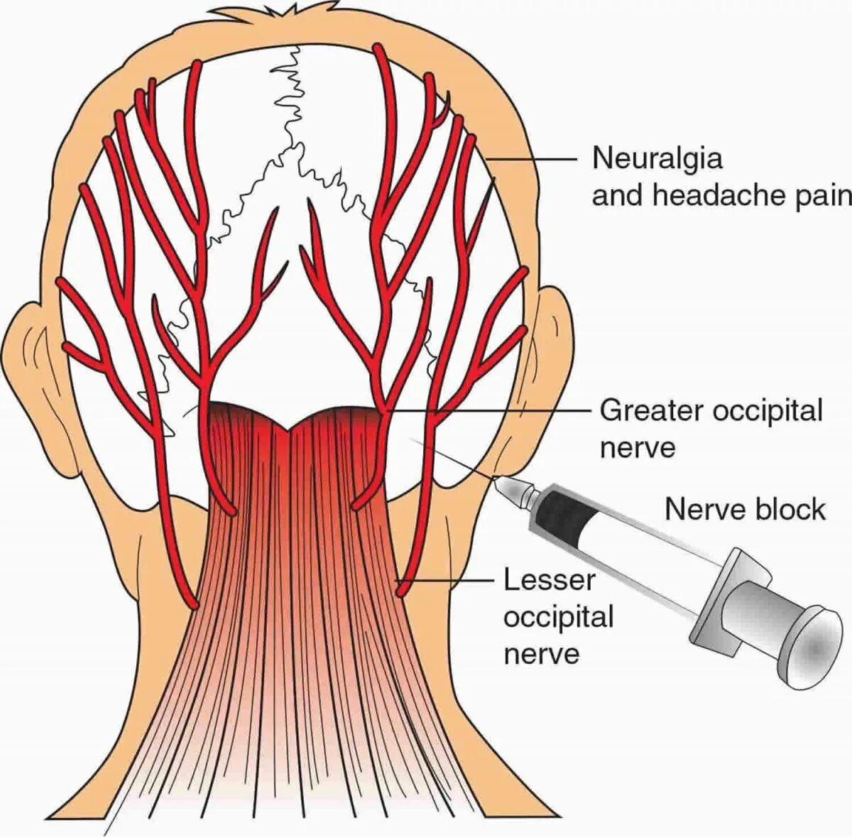 Болит шея у основания головы. Блокада большого затылочного нерва. Подзатылочный нерв анатомия. Топографическая анатомия затылочного нерва. Большой затылочный нерв топография.