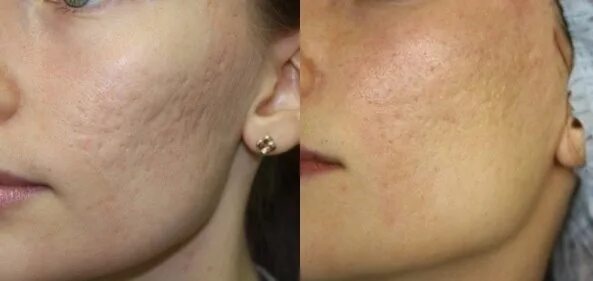 Microneedling treatment for skin (DERMAPEN) FreyaEstetica