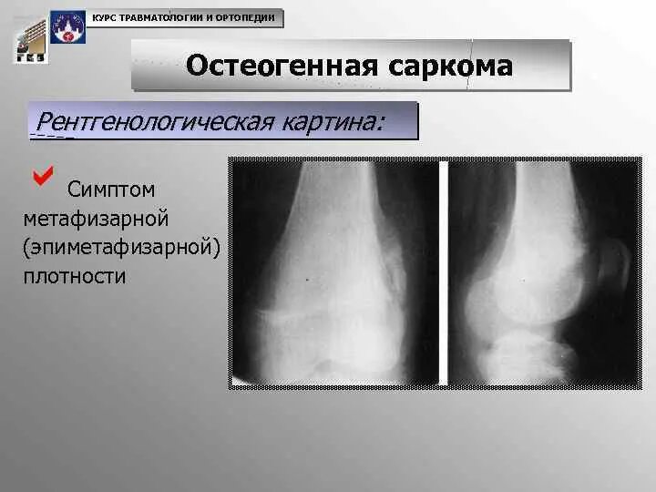Симптомы саркомы первые саркома. Рентгенологические признаки саркомы. Саркома юинга большеберцовой кости рентген. Саркома капоши лимфатических узлов. Опухоли костей презентация.