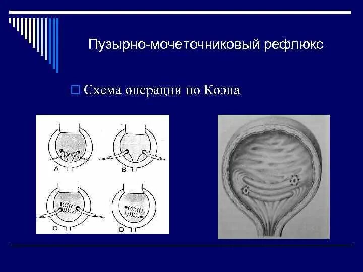 Рефлюкс мочеточника. Пузырно мочеточниковый рефлюкс операция. Реимплантация мочеточника по Коэну. Операция пузырно мочеточниковом рефлюксе.