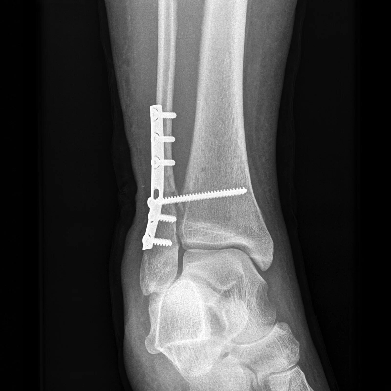 Fracture c. Fracture c