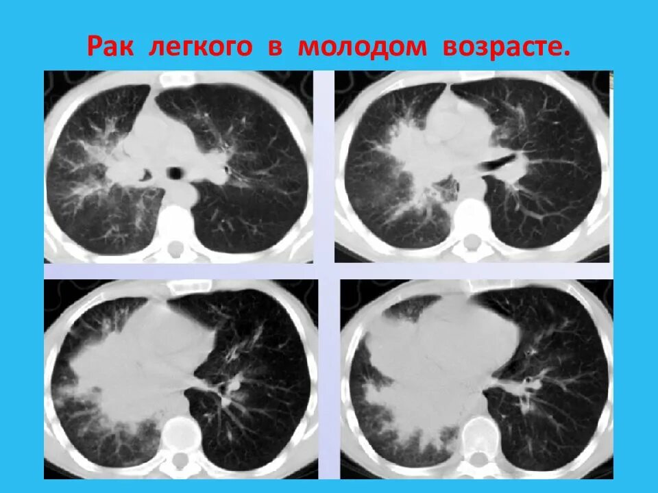 Центральный рак правого. Центральная карцинома легкого. Опухоль в s8 легкого. Центральный рак?. Субмукозная карцинома легкого.