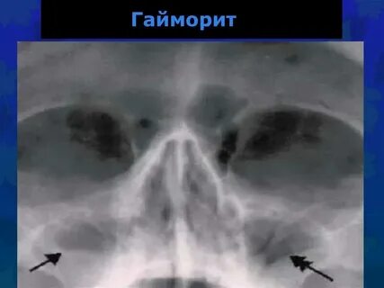 Острый гнойный двусторонний