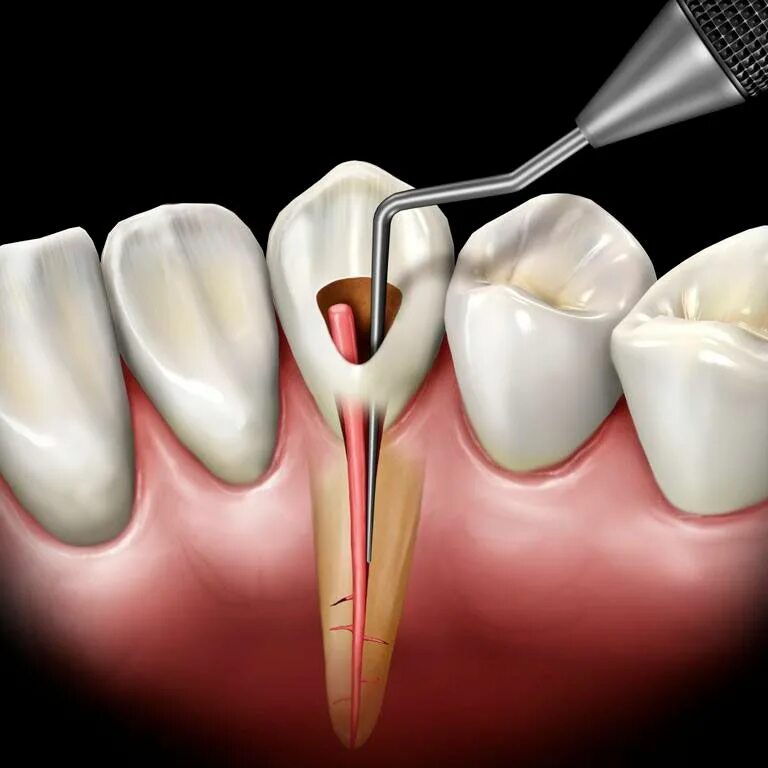 Воспаление канала зуба. Пульпит 2 канального зуба. Кариес пульпит периодонтит. Пломбирование пульпита.