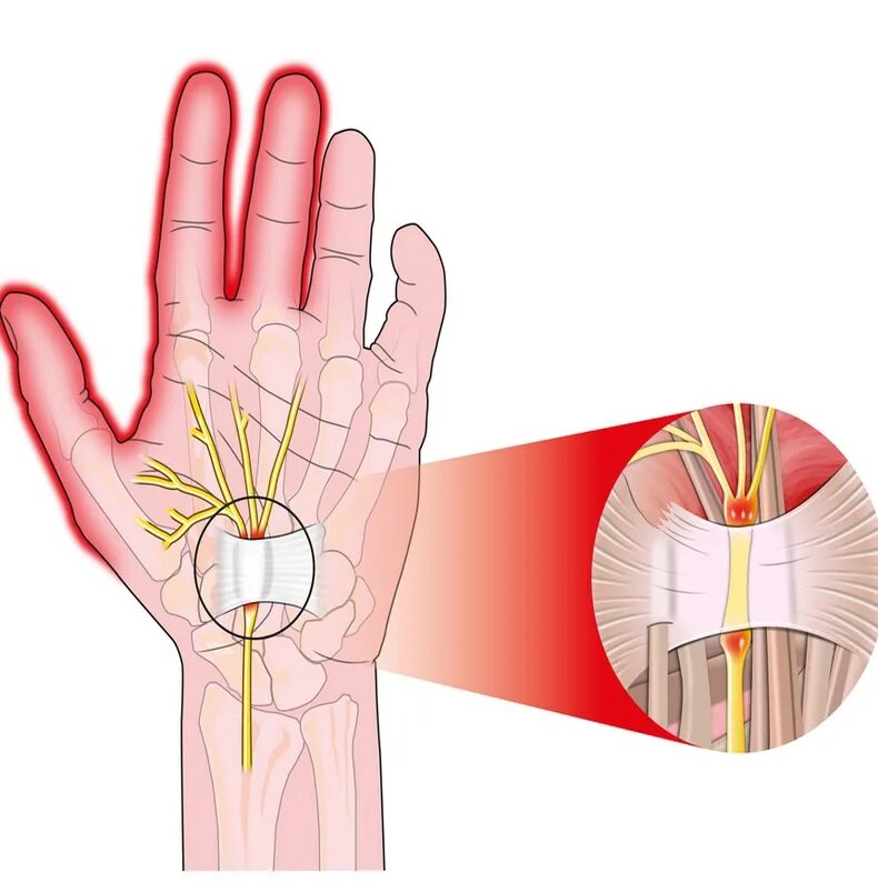Туннельный синдром врачи. Туннельный синдром лучезапястного сустава. Карпальный туннельный синдром. Синдром карпального канала кисти.