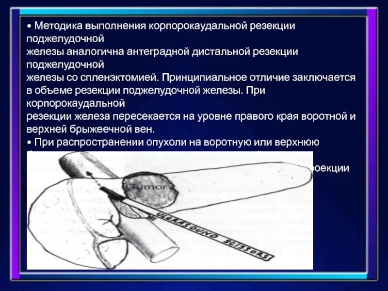 Корпорокаудальная резекция поджелудочной железы этапы. Дистальная резекция поджелудочной железы. Дистальная корпорокаудальная резекция поджелудочной железы. Резекция поджелудочной железы операция.