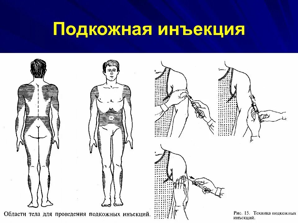 Подкожная инъекция. Введение подкожной инъекции. Места проведения подкожных инъекций. Подкожная инъекция схема. Подкожные инъекции техника выполнения