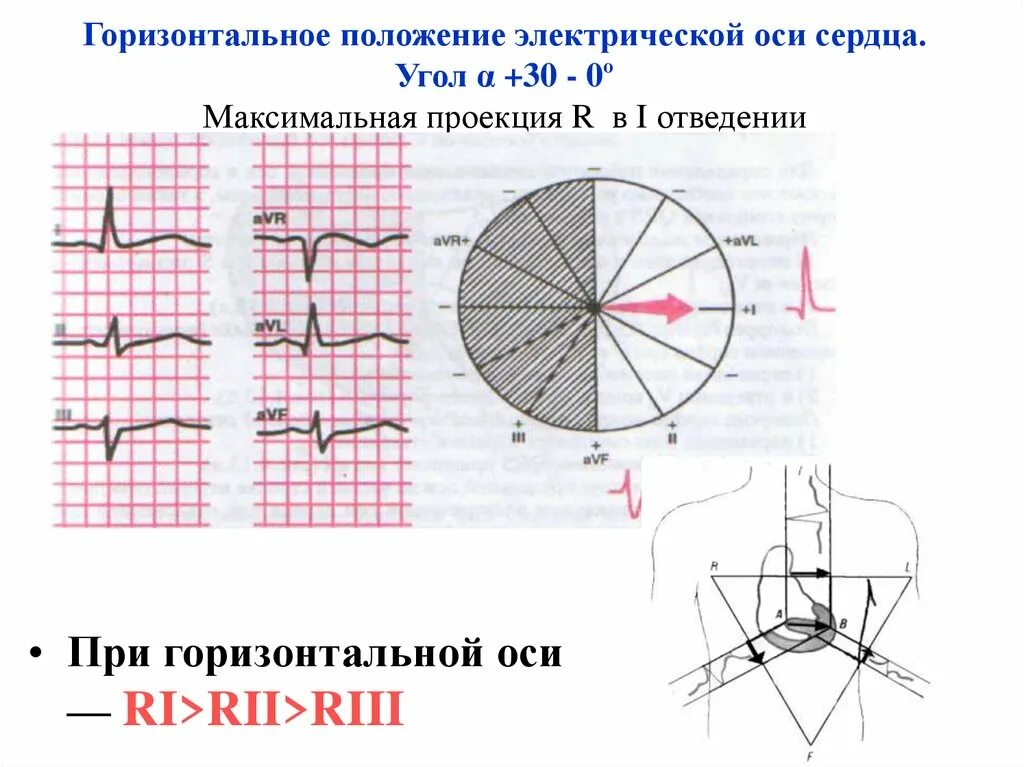 Экг горизонтальное положение что это. Эос сердца на экг горизонтальная. вертикальная и горизонтальная ось сердца на экг. горизонтальное направление электрической оси на экг. горизонтальная электрическая ось сердца на экг.