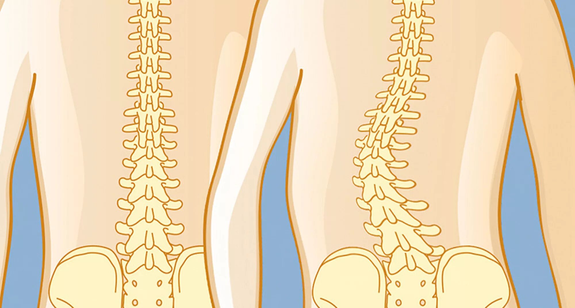 Искривленный позвоночник. Люмбальный сколиоз.