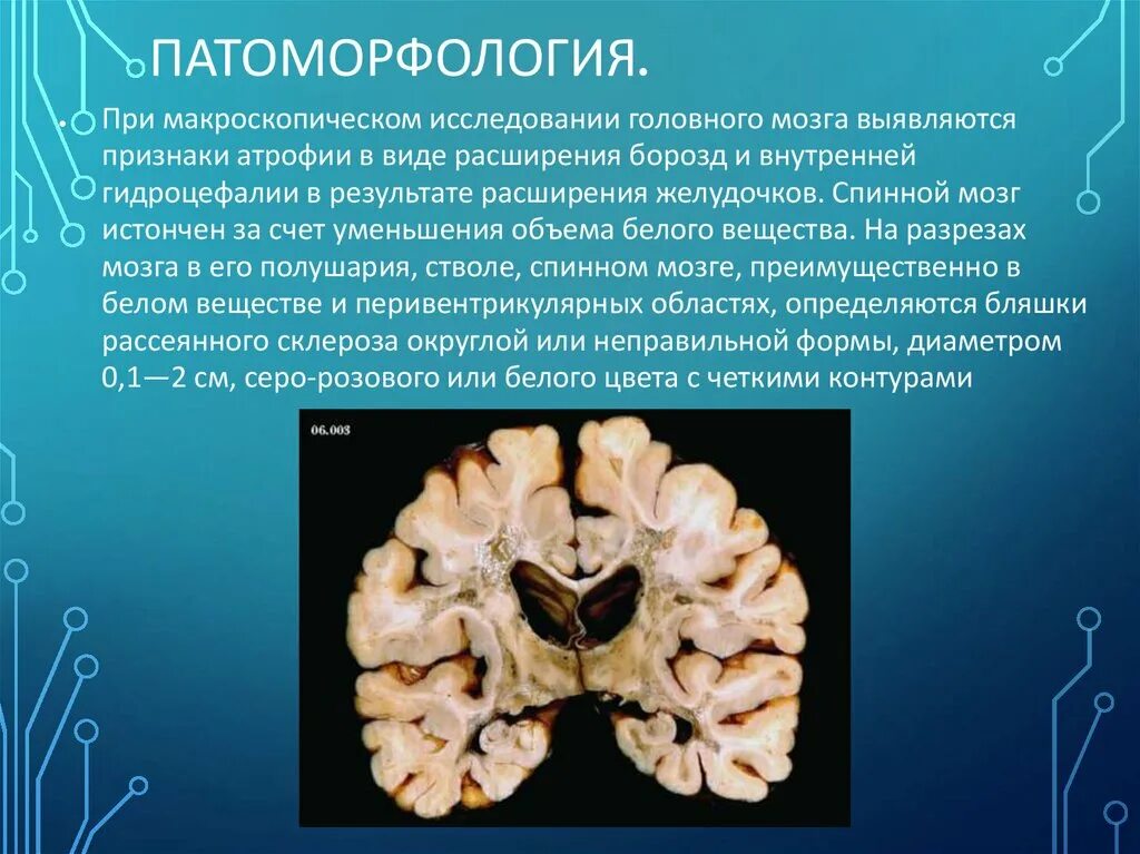 Атрофия головного мозга 1. Рассеянный склероз Макропрепараты. Рассеянный склероз головного мозга. Рассеянный склероз патологическая анатомия. Патоморфология при рассеянном склерозе.