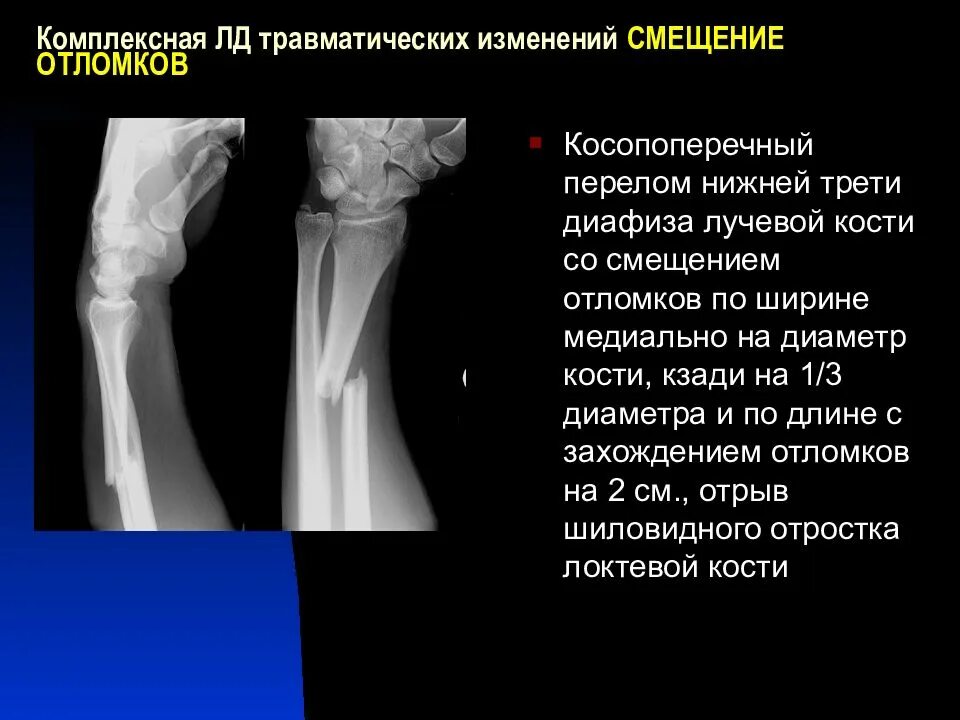 Травматические повреждения костей. Трещина головки локтевой кости. Классификация травматических чло. Травматические повреждения костей. Рентгенодиагностика костей и суставов.