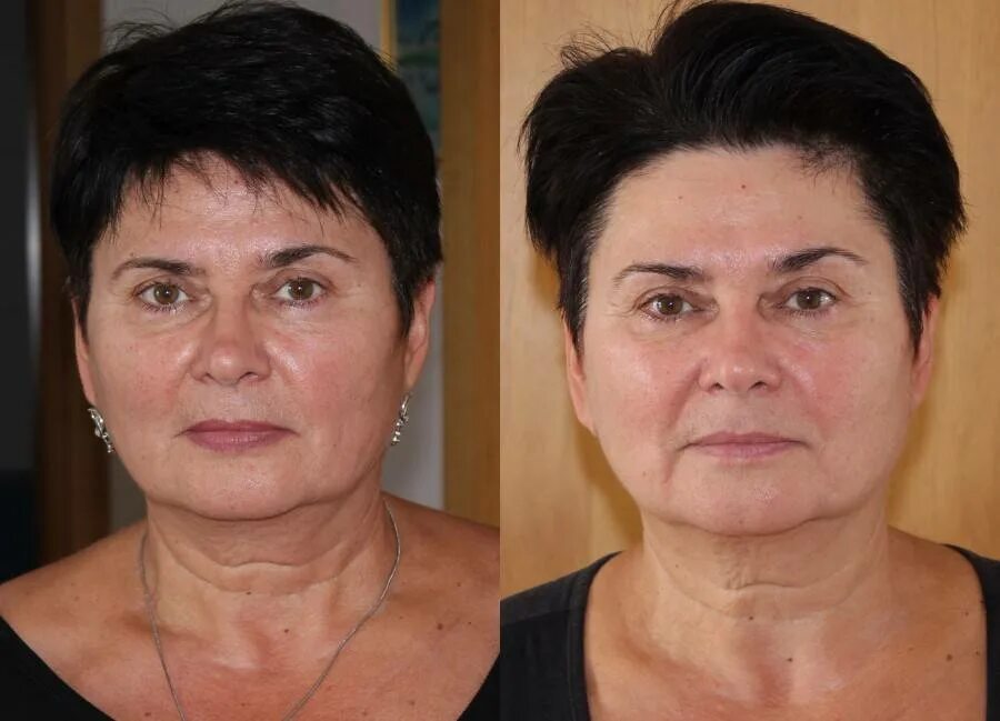 Буккальный массаж до и после. Массаж лица до и после. Моделирующий массаж лица до и после. Броссаж лица до и после. Скульптурный массаж лица до и после.