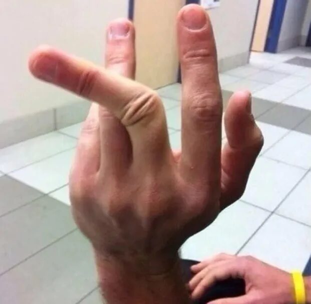 Бьющие пальцы. Бьющие пальцы. Перелом среднеготпальца. Вин чун. Бьющие пальцы.