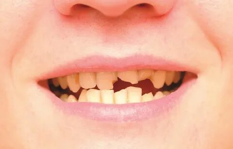 Bare teeth
