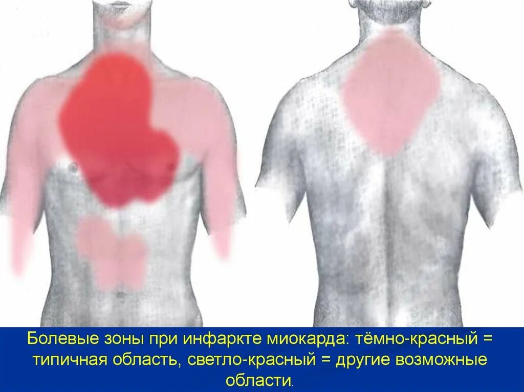 Иррадиация боли при инфаркте миокарда. Болевые зоны при инфаркте миокарда. Зоны иррадиации боли при остром инфаркте миокарда. Инфаркт миокарда локализация боли.