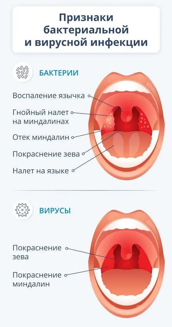 Причины першения в горле. Причины першения в горле