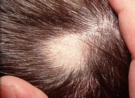 Почему нету головы. Очаговая алопеция (alopecia Areata).