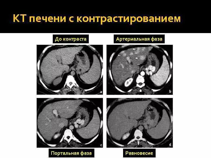 Портальная фаза контрастирования при кт. Динамическое контрастирование печени мрт. Мрт с контрастом фазы. Кт с контрастом печени фазы. Кт норма печень