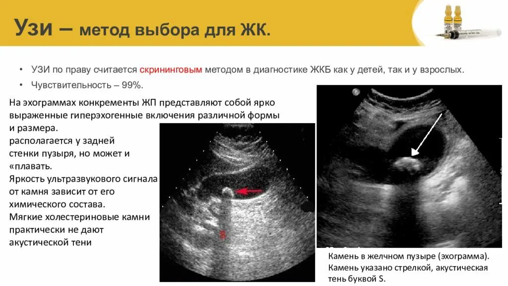 Эхопризнаки желчного пузыря. УЗИ признаки желчекаменной болезни. УЗИ признаки камней в желчном пузыре. УЗИ желчного пузыря ЖКБ. Камень в желчном УЗИ признаки.