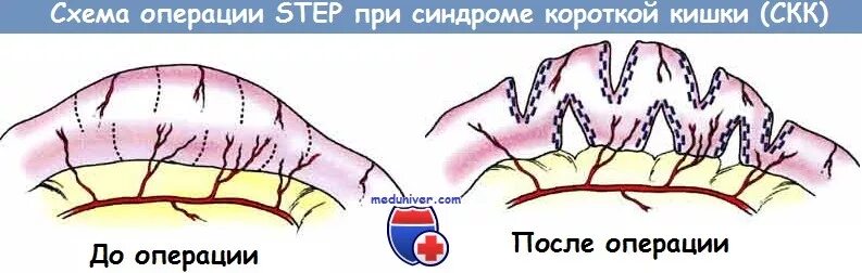 Operation step. Operation step. Multi step analysis в фемап. Удлинённый кишечник операция. Md5 algorithm functions.