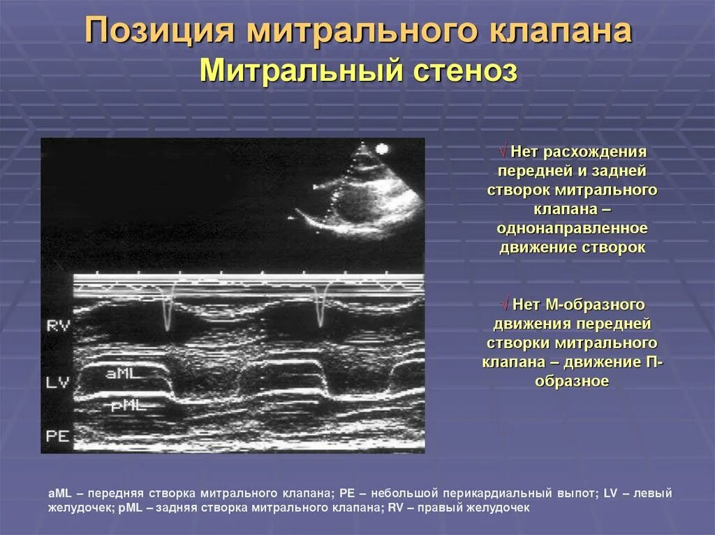 П образное движение створок митрального клапана. Однонаправленное движение створок митрального клапана. Передняя створка митрального клапана на Эхо. ЭХОКГ при митральном стенозе. Митральный стеноз признаки