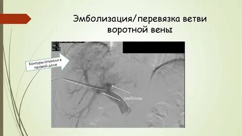 Химиоэмболизация печени отзывы